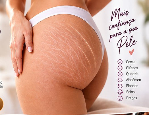 Imagem ilustrativa de estrias